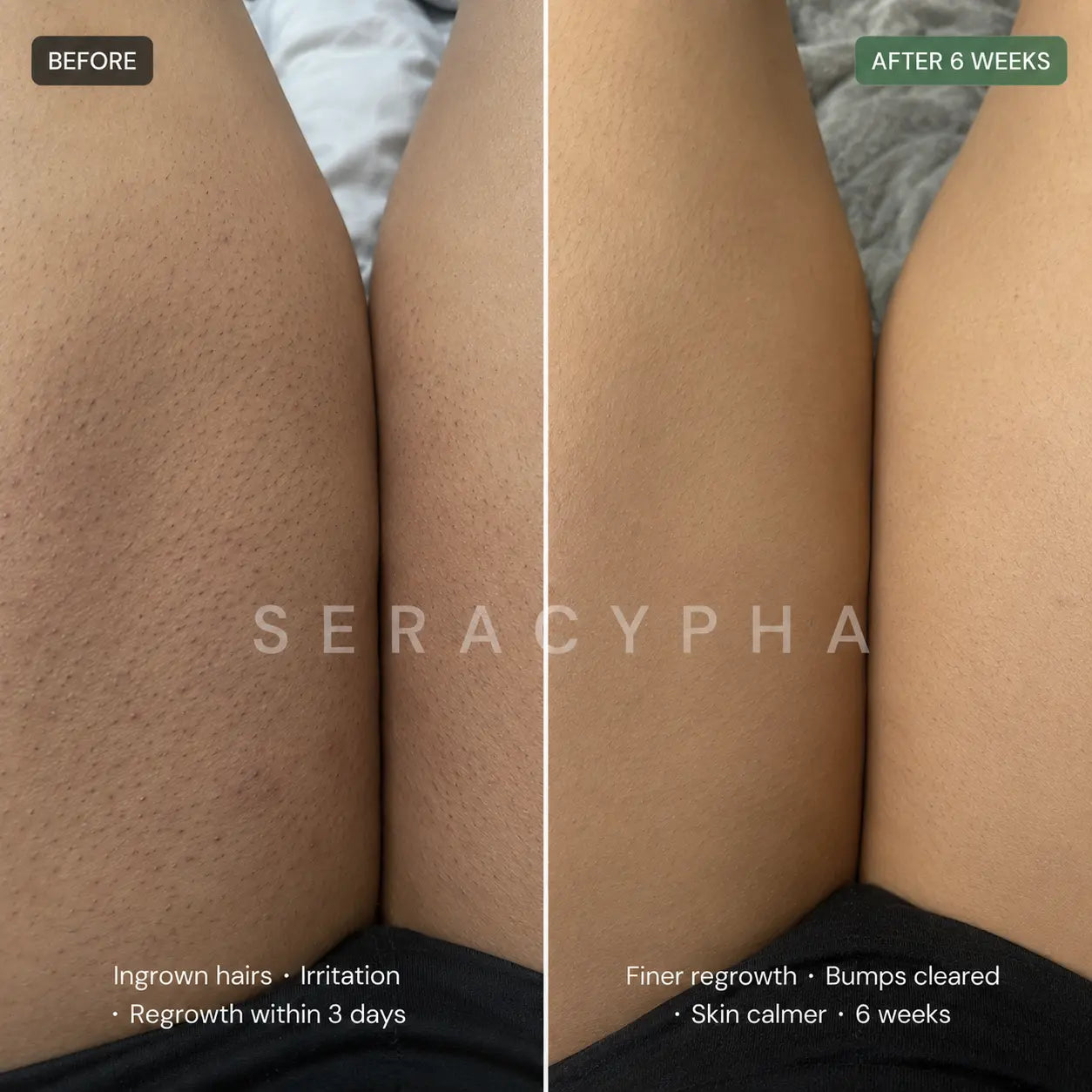 Seracypha™ Cyperus Rotundus Skin Serum - Stop Unwanted Hair Growth Naturally