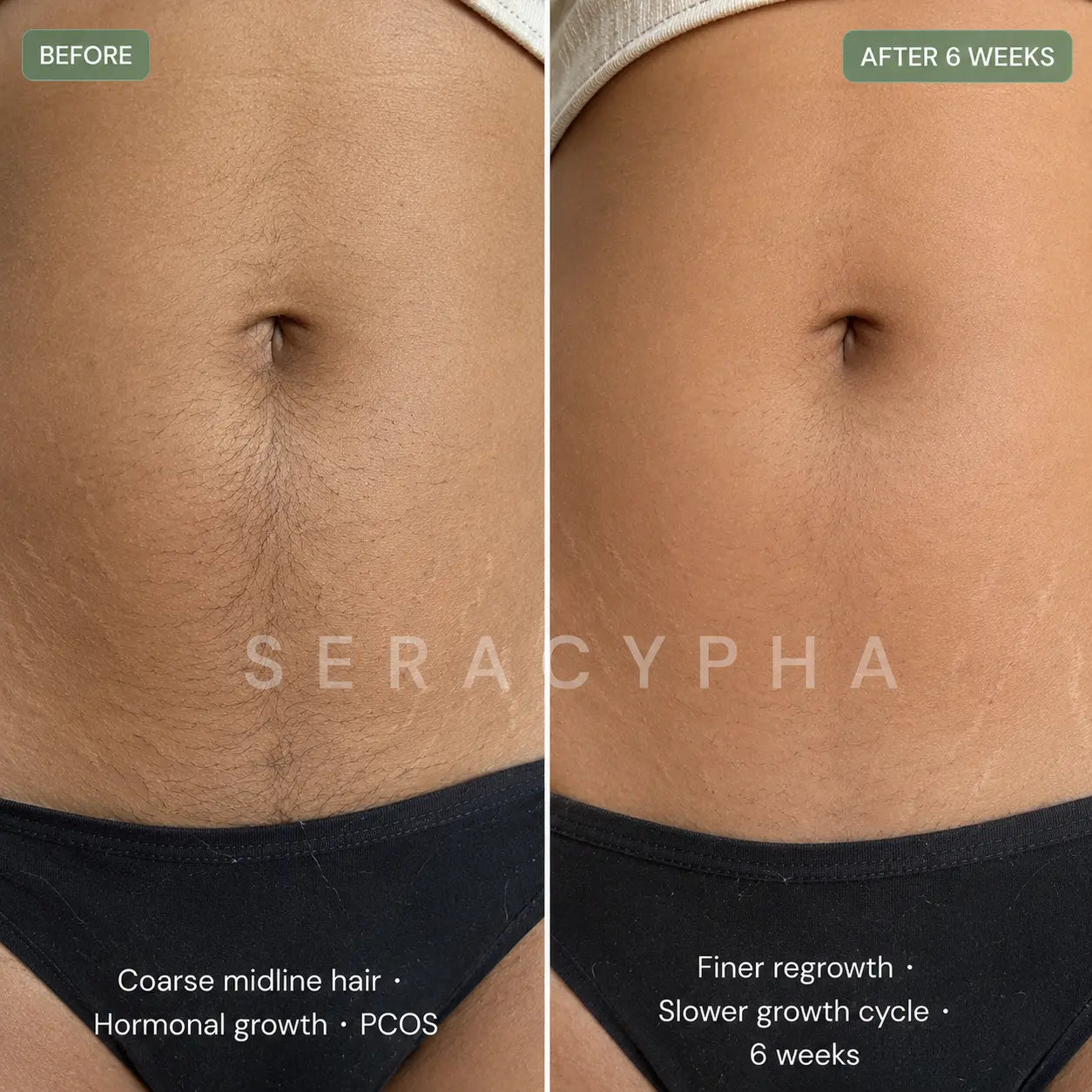 Seracypha™ Cyperus Rotundus Skin Serum - Stop Unwanted Hair Growth Naturally